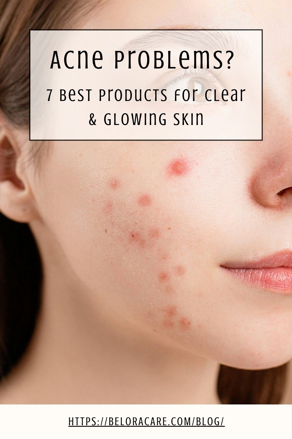 7 Best Acne Products That Actually Work (Clear Skin Fast in 2026)